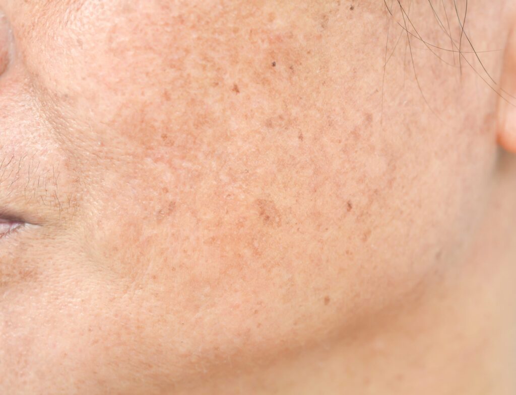 przebarwienia skórne typu melasma